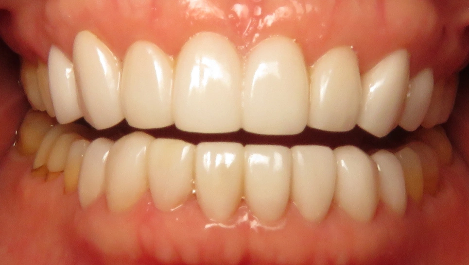 Close-up of dental veneers displaying bright, evenly aligned teeth in a smile.
