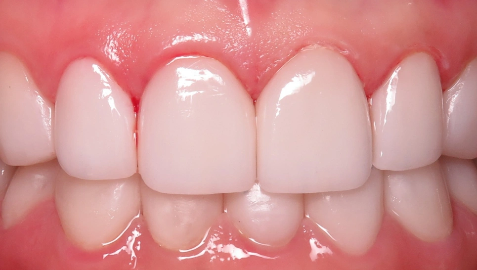 Close-up of healthy white teeth and pink gums in dental setting, showcasing natural smile aesthetics.