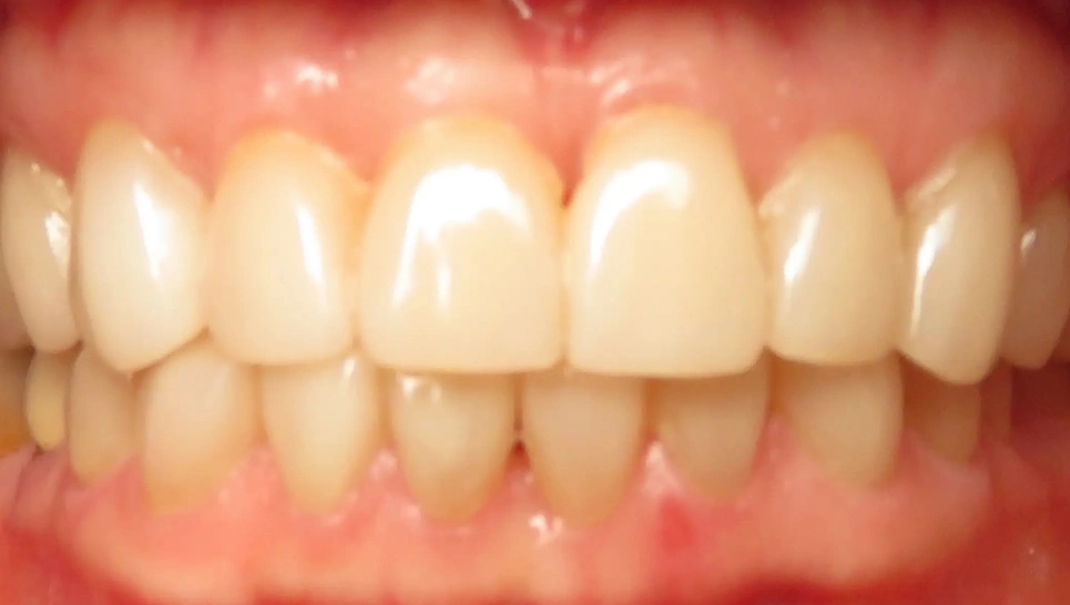 Close-up of healthy upper teeth showing natural white smile against pink gum tissue