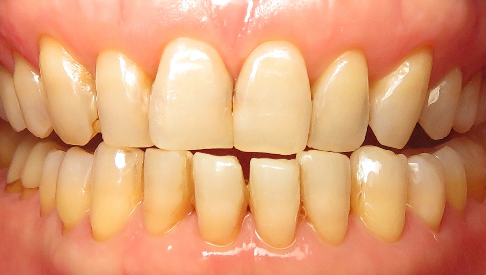 Close-up of natural teeth showing upper and lower dental arches in mouth.