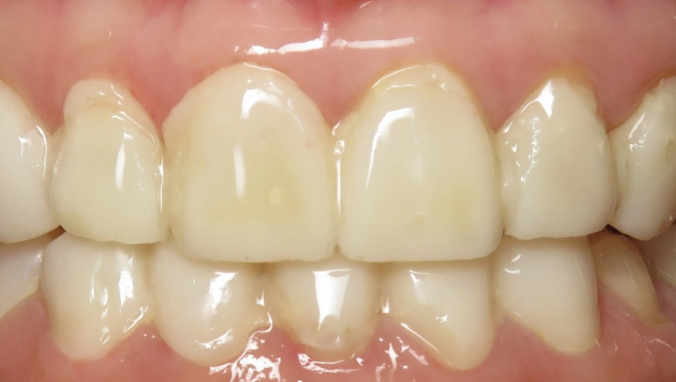 Close-up of natural-looking dental veneers or crowns on upper front teeth showing bright, even smile.