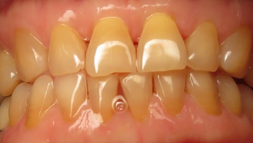 Close-up of upper and lower teeth showing dental crowns and tooth discoloration in clinical setting.