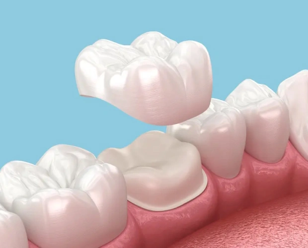 3D dental crowns and bridges displayed on pink gum model against blue background.
