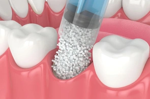 Bone graft Dallas- SK2 Dental