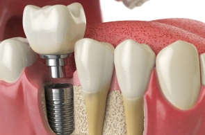 Dental Implant Dallas- SK2 Dental