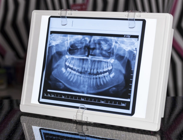 Dental X-ray display showing panoramic radiograph on monitor in clinical setting.