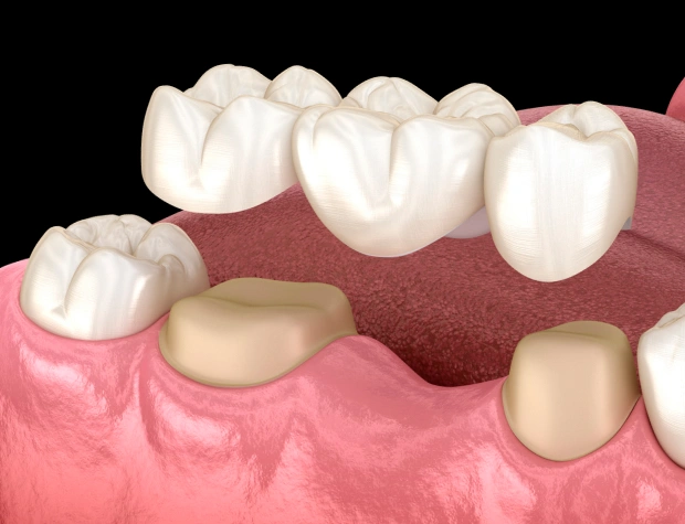 3D dental illustration showing tooth implant placement procedure with crown restoration on gum tissue model.