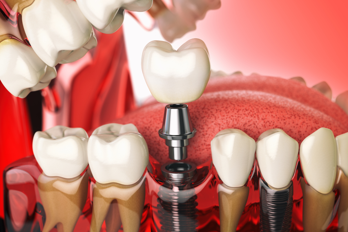 7 Warning Signs Your Missing Tooth Problem May Be Getting Worse Faster Than You Think in Dallas